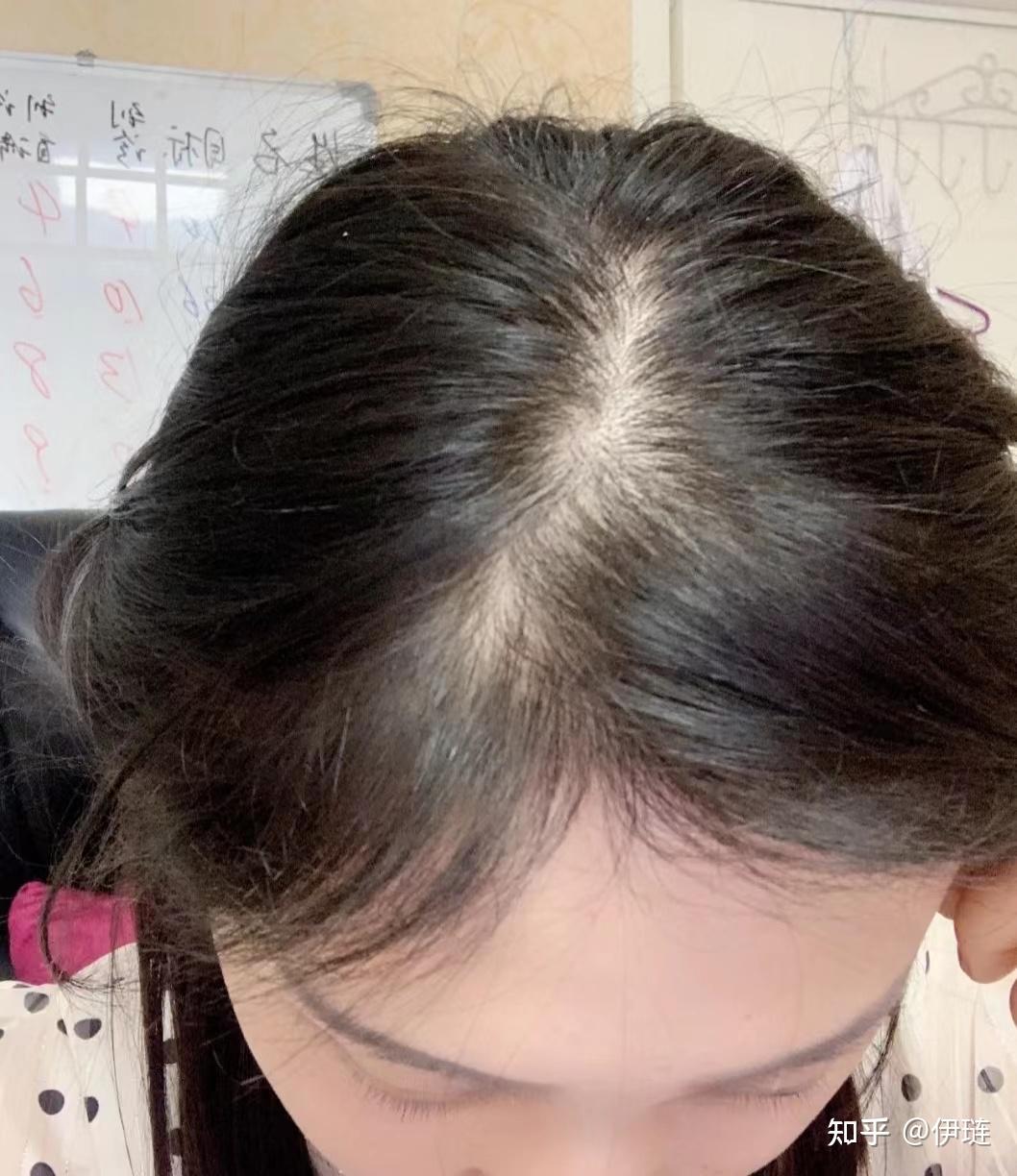 头顶上发缝很大,每天坚持吃维B能让头发变多吗? - 知乎