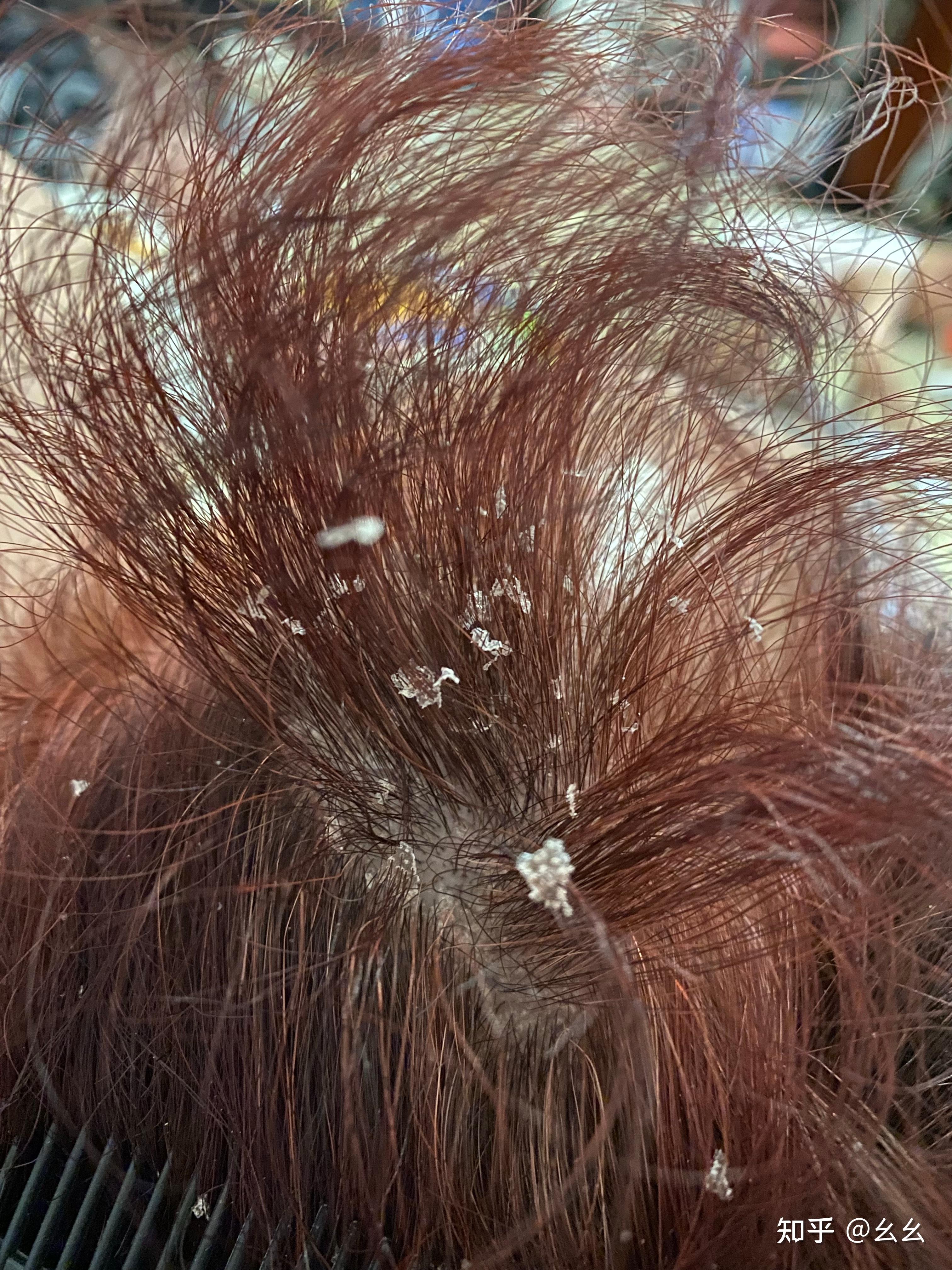 见过的最大头皮屑多大