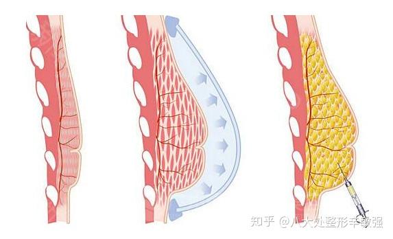 下面是自體脂肪隆胸的原理圖:之前就有醫生用自體脂肪移植的方法來