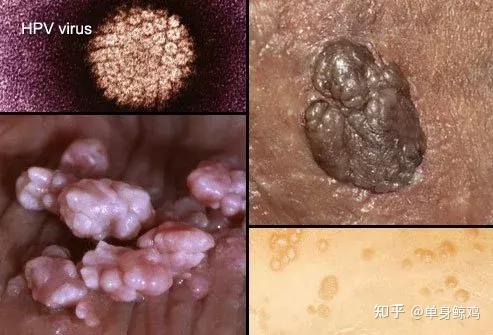 阴囊hpv感染的症状图片图片