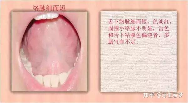 九种体质+珍贵的舌诊图谱! - 知乎