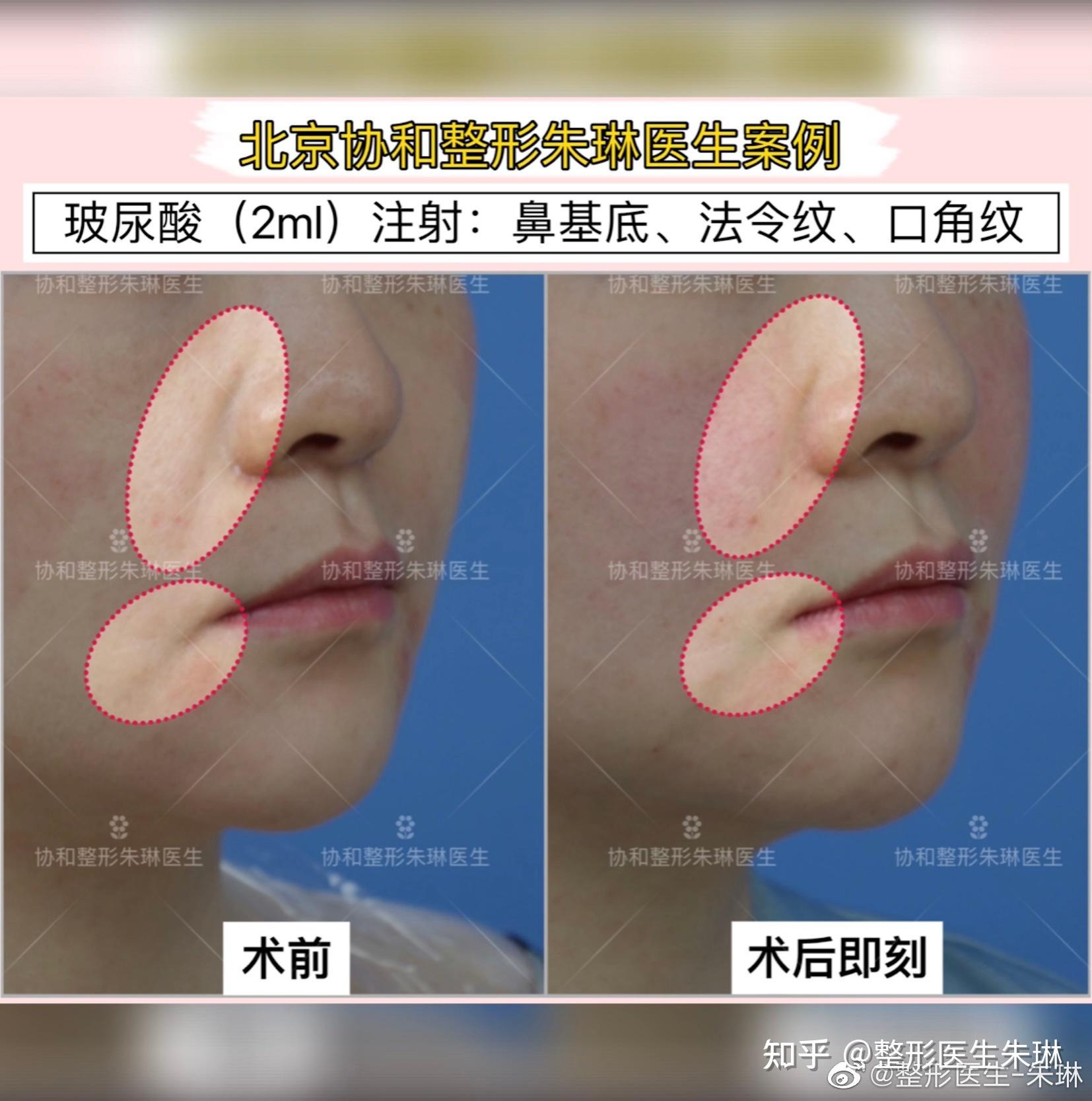 北京鼻基底、法令纹、口角纹注射，2ml玻尿酸注射术后即刻。 - 知乎