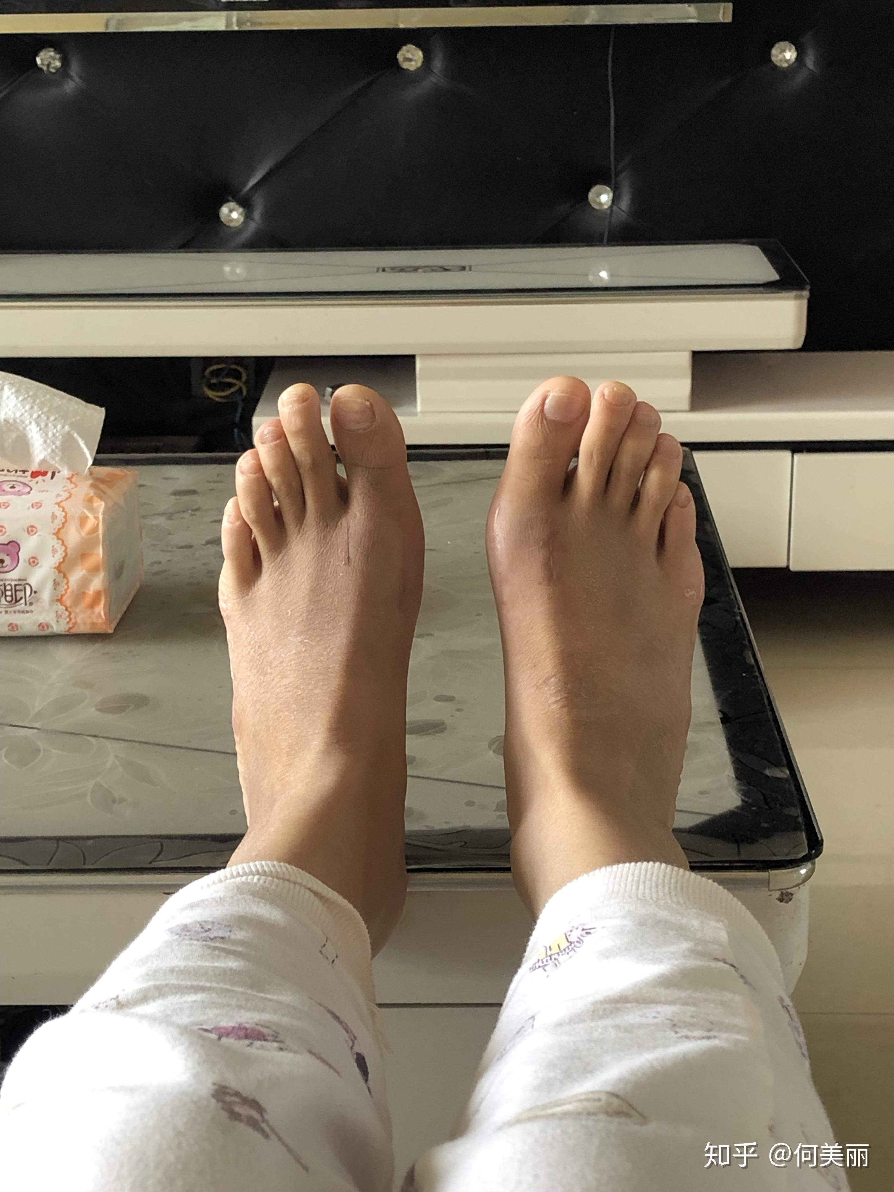 拇外翻术后一个月