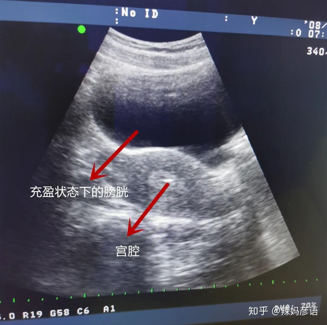 胚胎移植為什麼要憋尿超聲下引導移植有哪些優勢