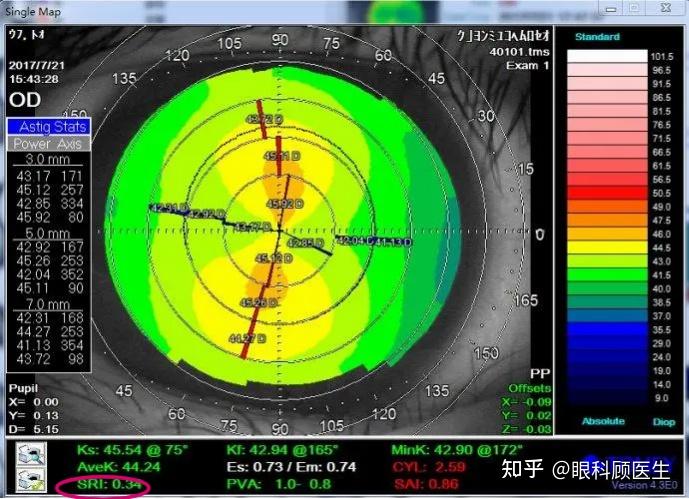 了解角膜形态的利器角膜地形图
