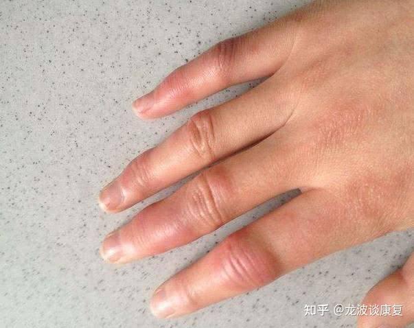 手指疼痛肿胀怎么办要尽早发现手指肿胀的原因