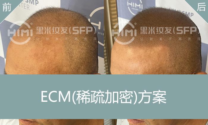 纹发头顶稀疏加密后效果怎么样？重现浓密发型 - 知乎