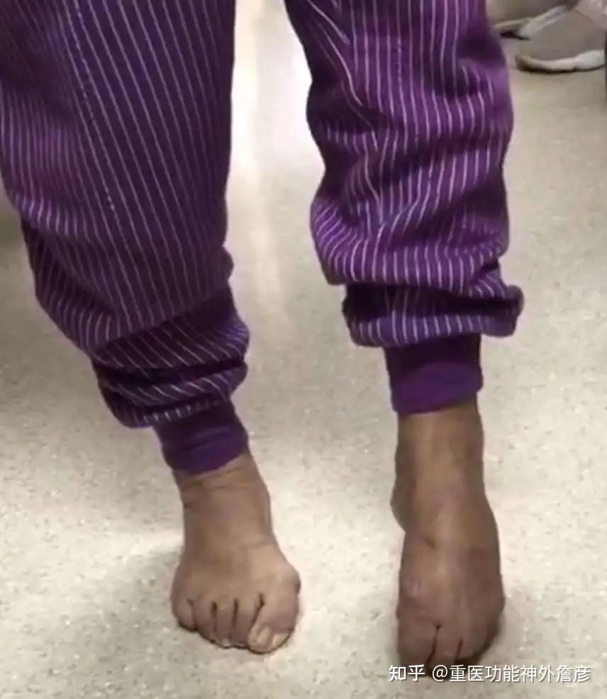 经常落枕崴脚还手抖写不好字小心是肌张力障碍