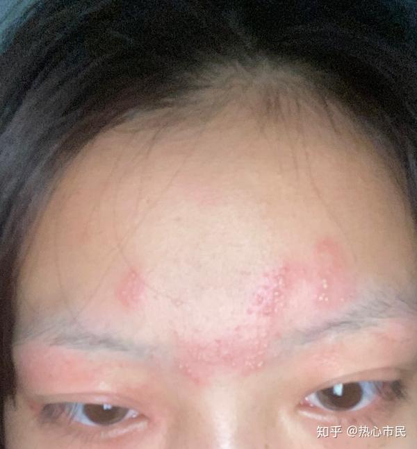 被隐翅虫毒液侵蚀的悲伤心情