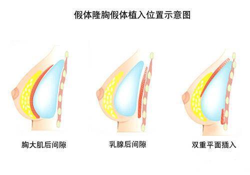 假体隆胸可以在植入假体的同时做乳房上提术,解决胸部下垂的问题