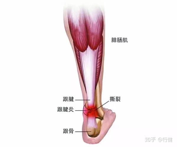 跟腱斷裂三個月後你開始慢跑了嗎