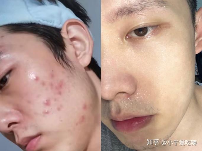 有哪些好用到飞起的男士祛痘护肤产品