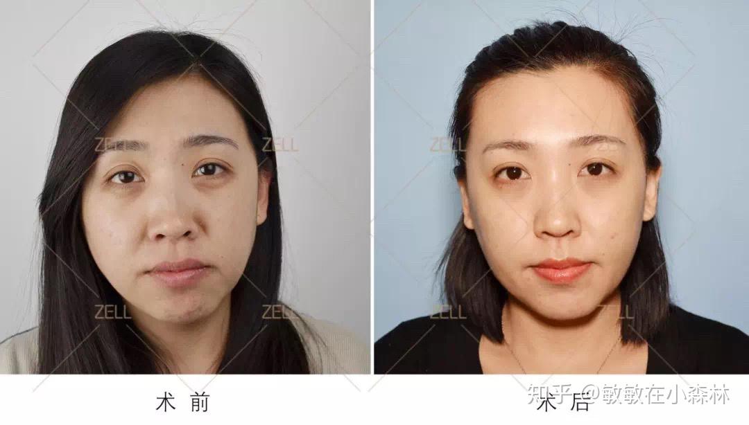 最全面部线雕提升功课图片纪实你想知道的全在这里