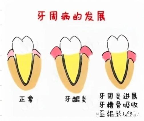 口腔知识06|牙周炎到底是不是病? - 知乎