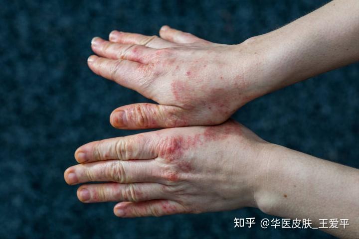 盘点手指上容易出现什么皮肤病?手癣、汗疱疹? - 知乎