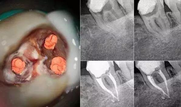 根管治疗的收费标准原来是 - 知乎