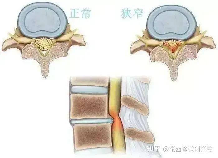 脊柱棘上韧带炎图片图片