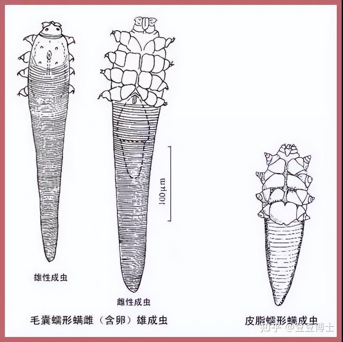 夏天,脸上有木有长螨虫?教你3招,轻松判断脸上的螨虫