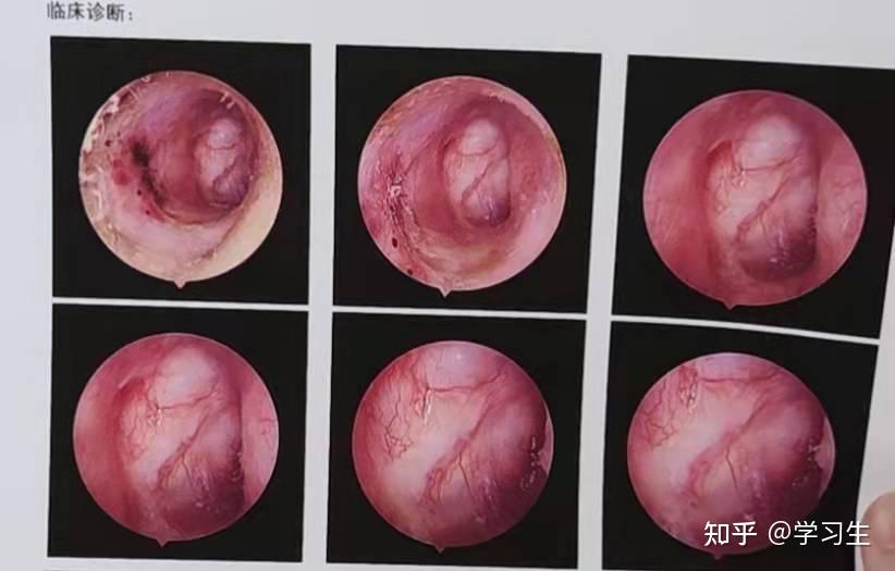 耳膜修复手术图片