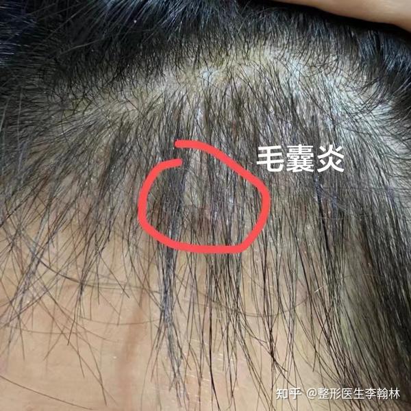 植发后的毛囊炎要怎么处理? - 知乎