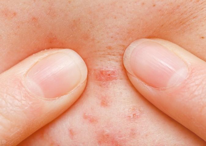 挤不掉又消不了的闭口粉刺难道只能让它留在脸上了