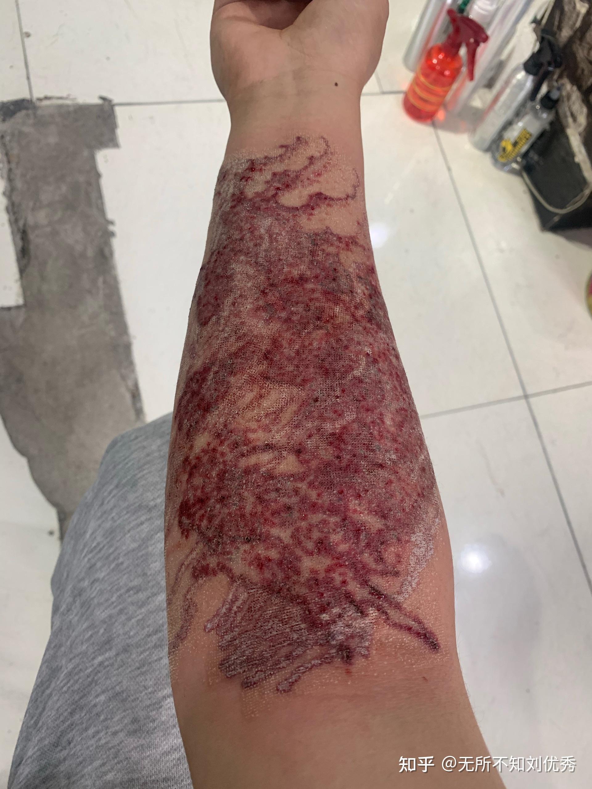 2021年2022年记录一下亲身体验超皮秒洗纹身彩色的经历