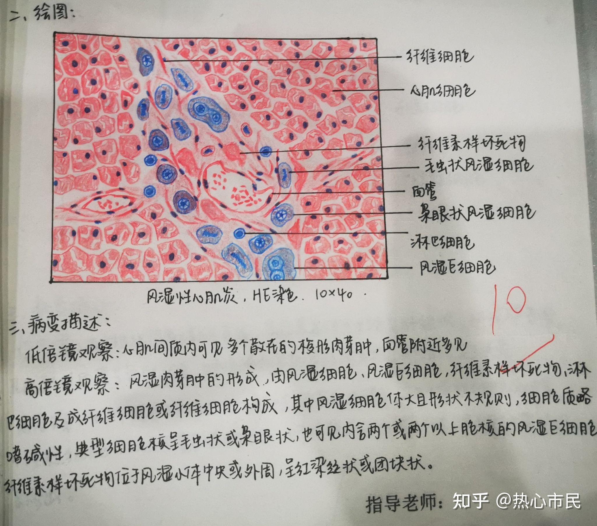 肺淤血切片图手绘图图片