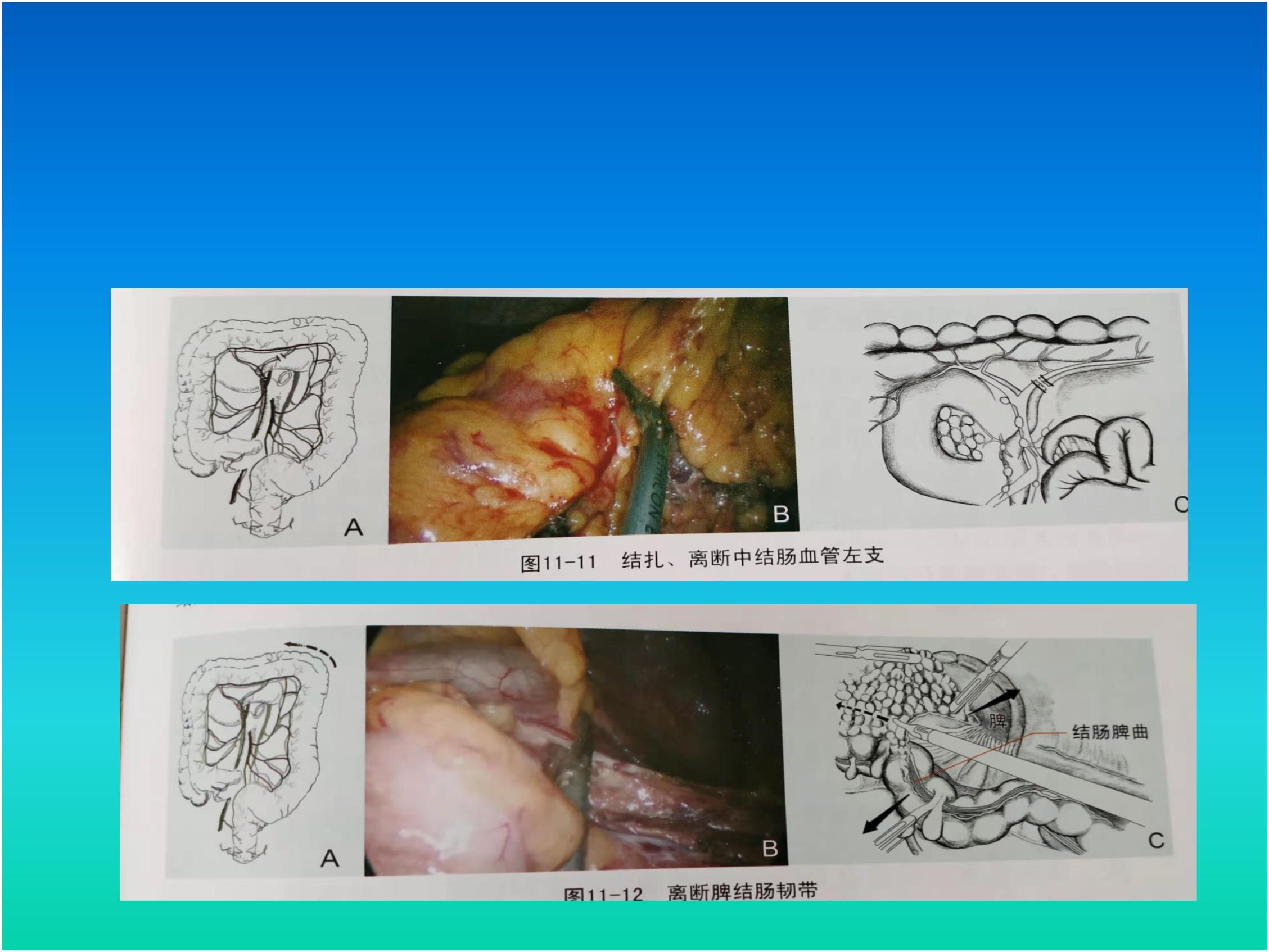從切口拉出結腸及其系膜,在體外直視下切除病變腸管,吻合腸管