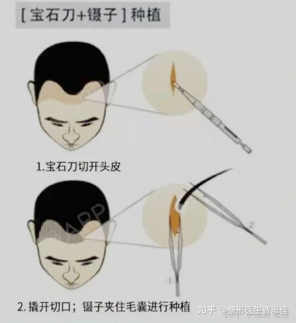 植发讲述(植发的经历)