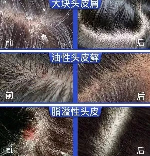 初中生头皮屑多用什么洗发水?控油去屑蓬松洗发水排行榜 - 知乎