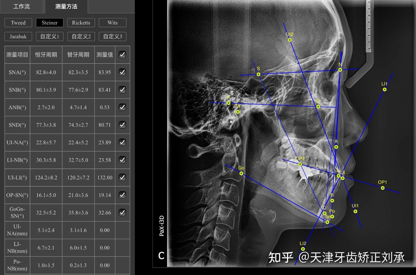 全景x光片显示下颌骨的水平部和升支都有明显的长度不一致,关节形态