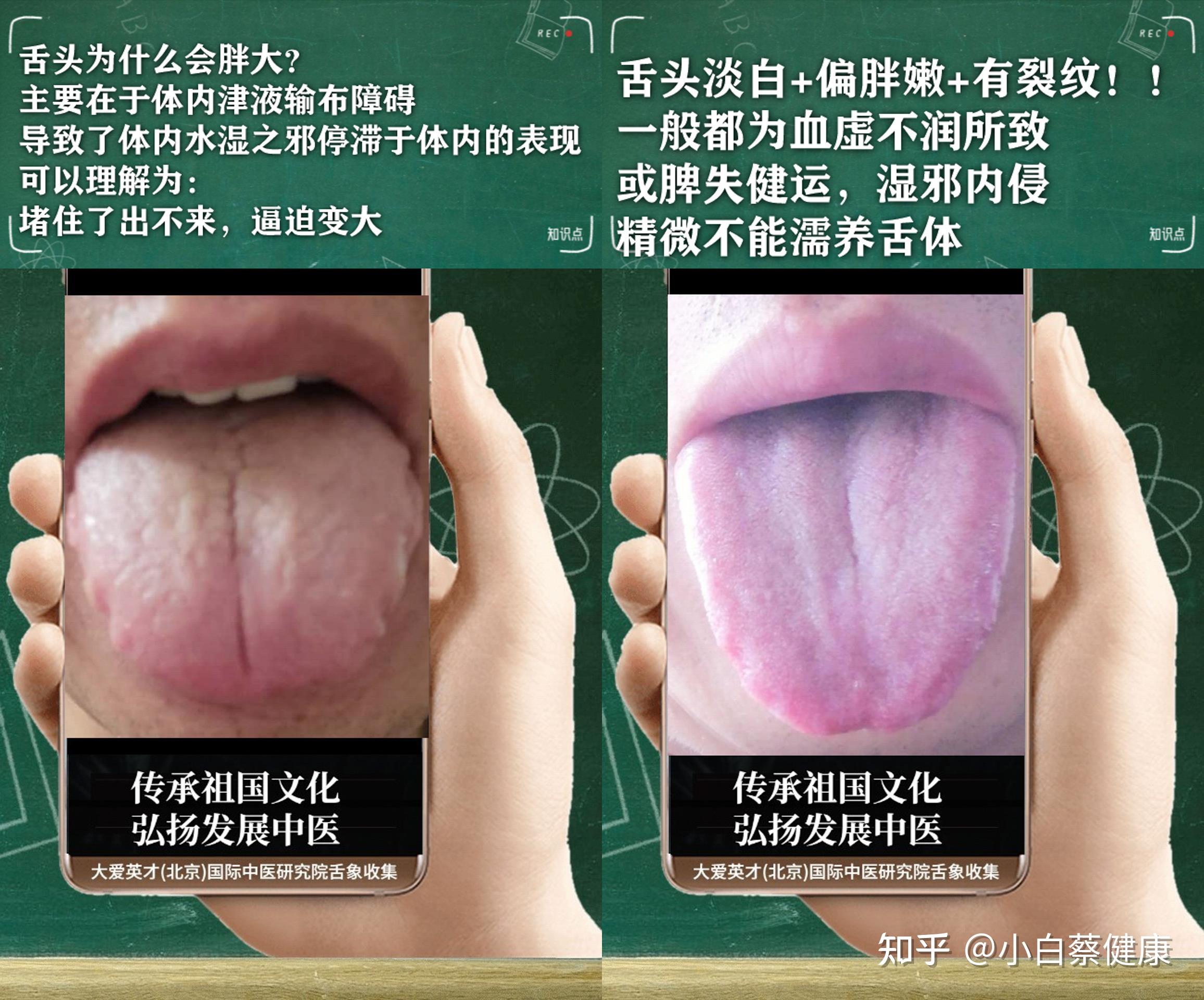 中医案例:常恐惧,工作效率低下,咳嗽重,吐黏痰 - 知乎