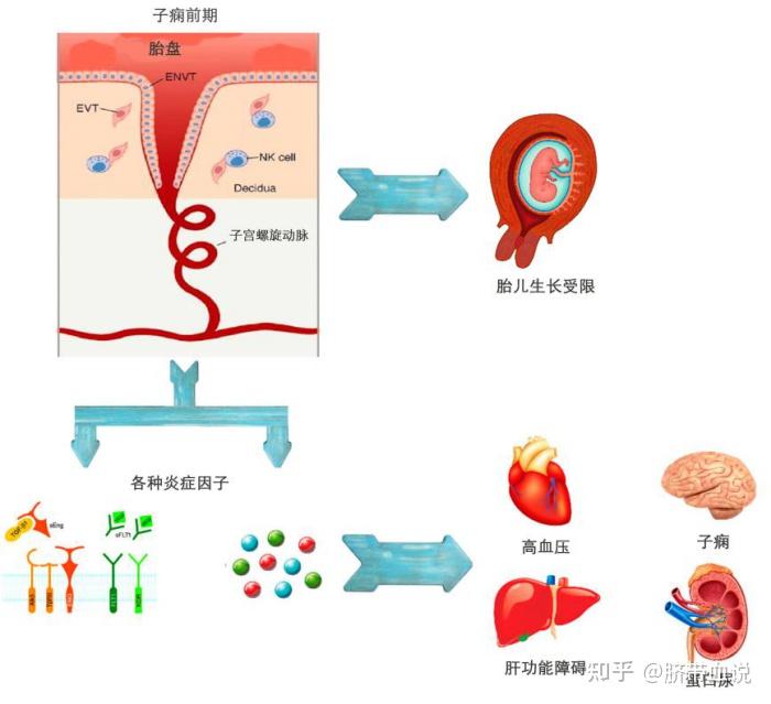 祝你好孕｜远离孕期“隐藏杀手”，一文读懂妊娠期高血压 - 知乎