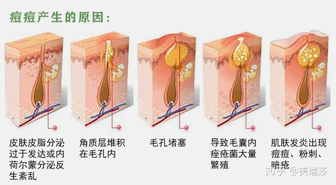 青春痘粉刺暗瘡的形成和日常清潔