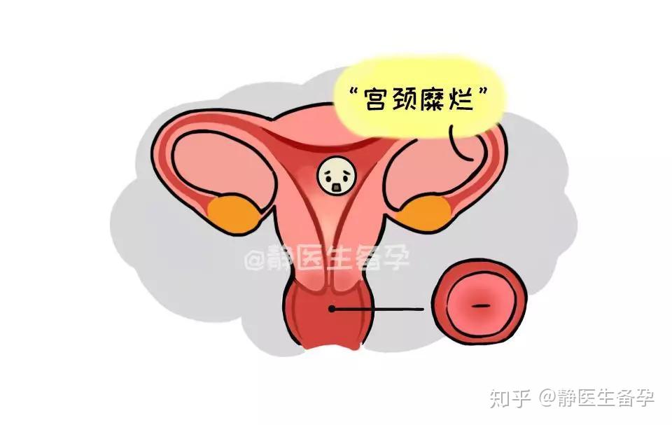 宫颈糜烂会影响怀孕吗图片