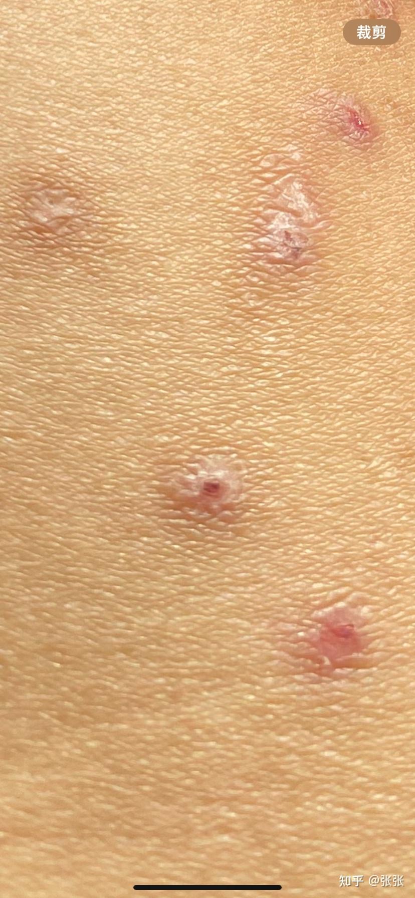 皮肤起芝麻一半大小的肉色的丘疹,抠破变结节性痒疹是为什么