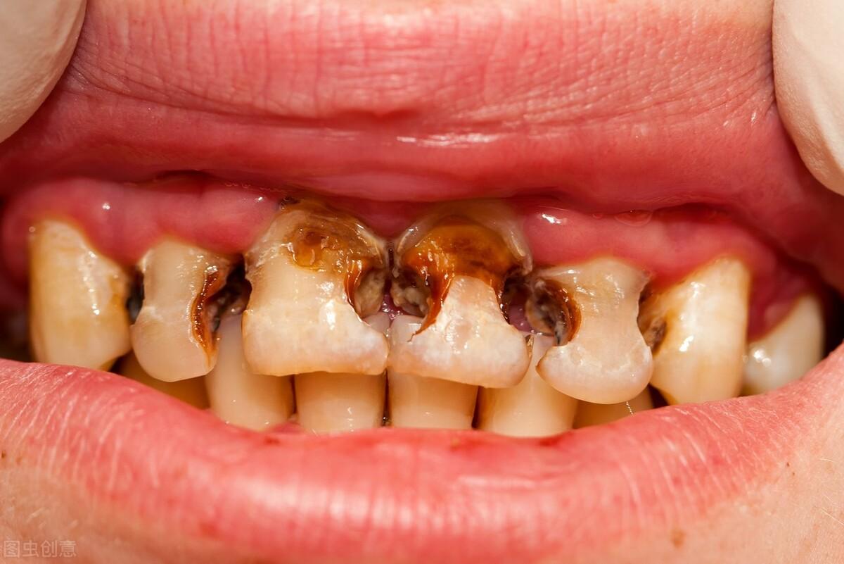 氟斑牙要怎样治疗这4种方法很重要