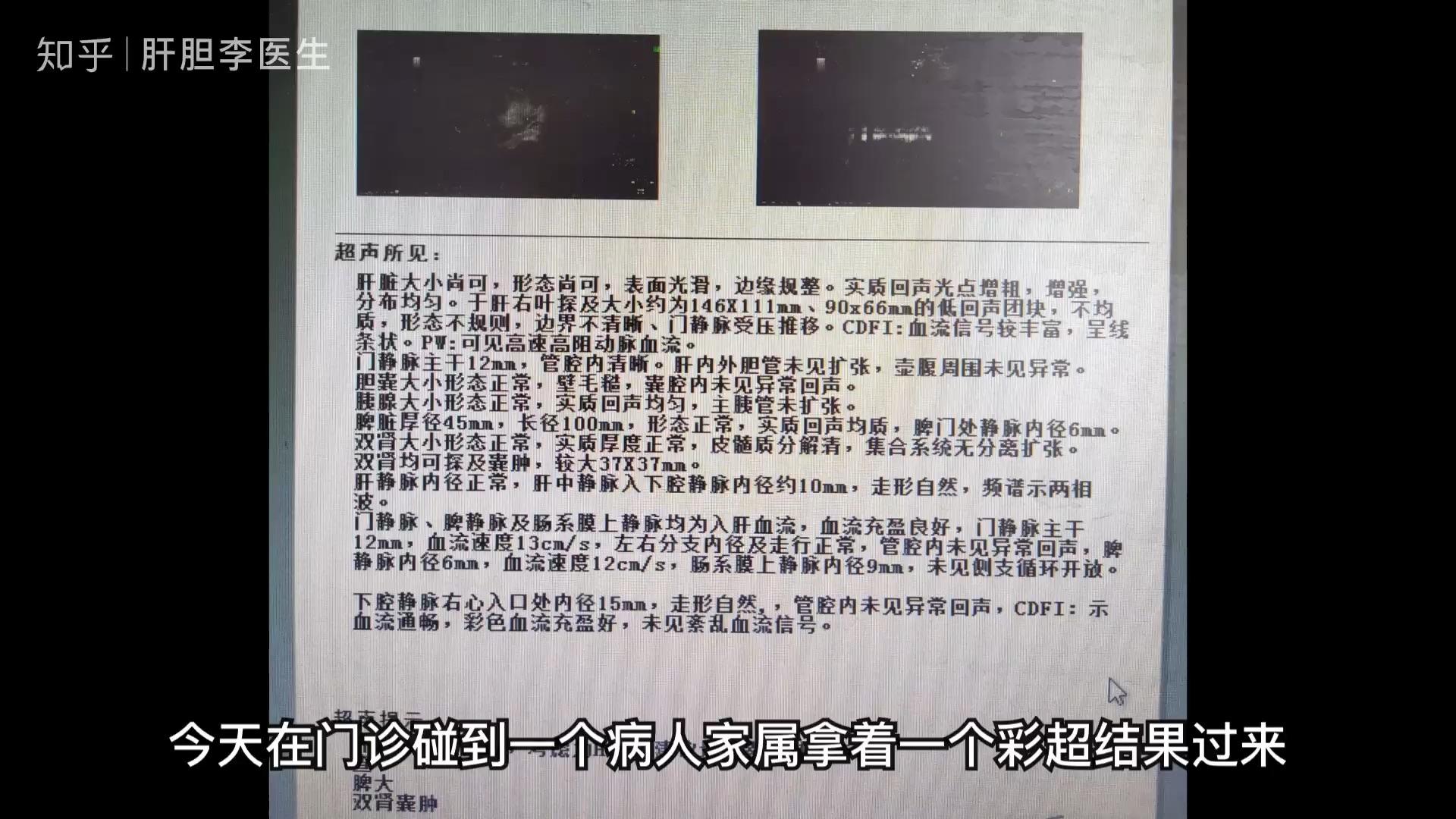 彩超提示胆囊壁增厚,粗糙,欠光滑就一定是胆囊炎吗?