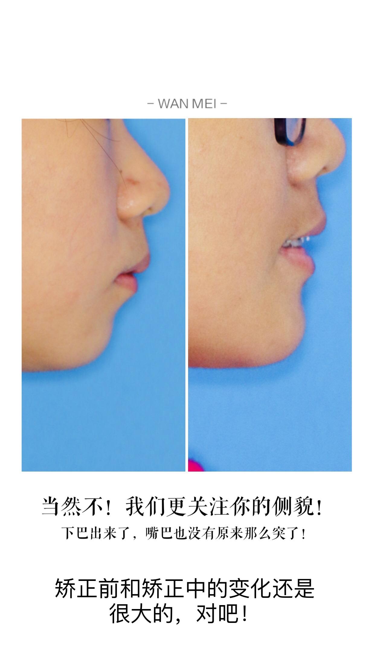 牙齿天包地 拔掉前磨牙后进行矫正 会改变脸型