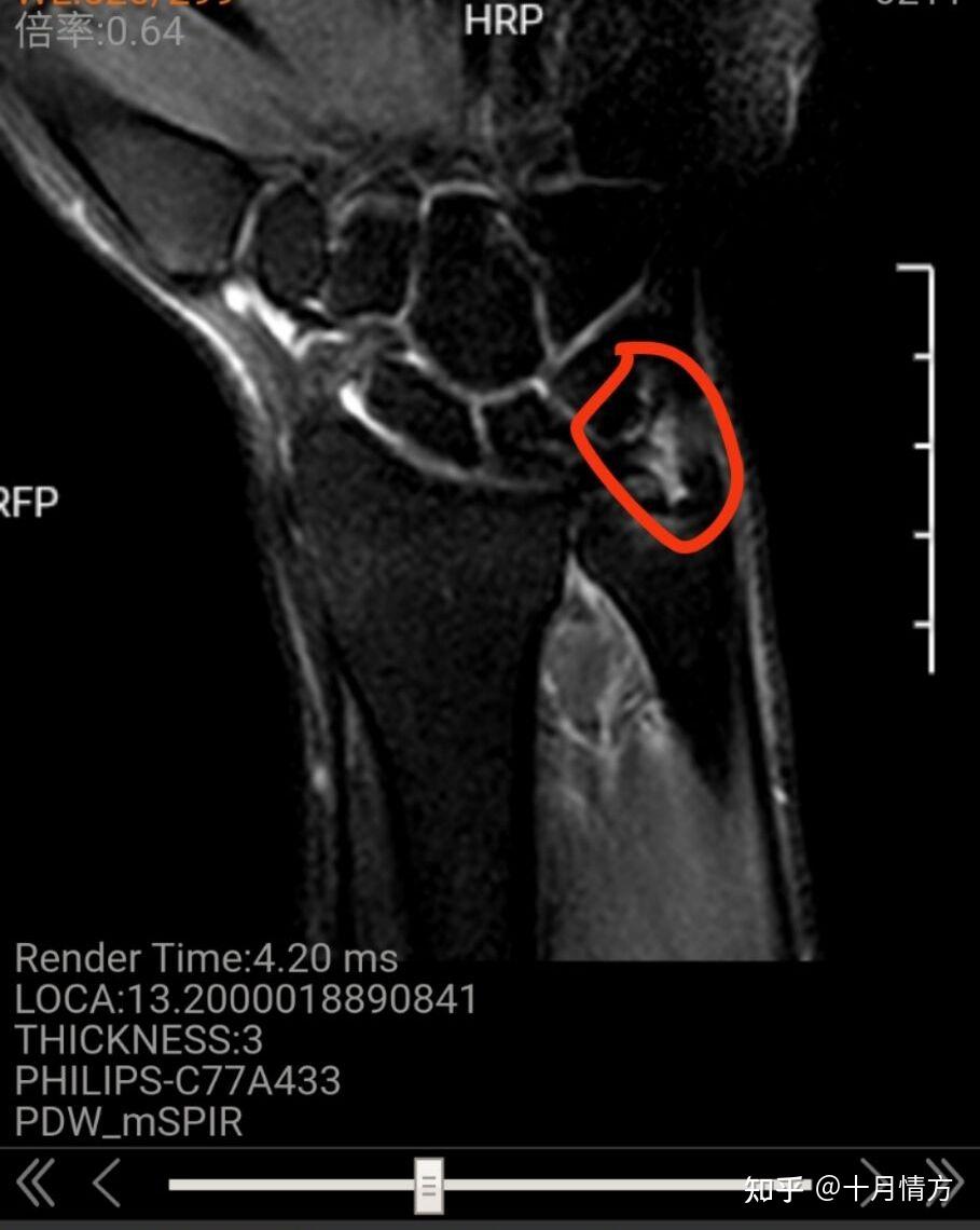 Tfcc患者的恢复 - 知乎