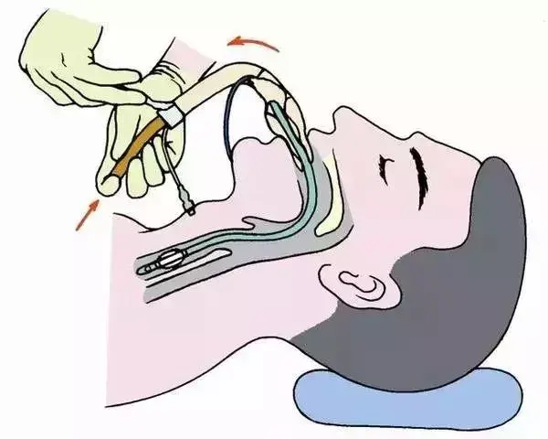 临床各种管道护理