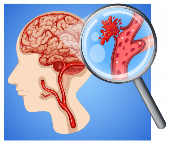 别忽视脑血管疾病的危害你知道吗