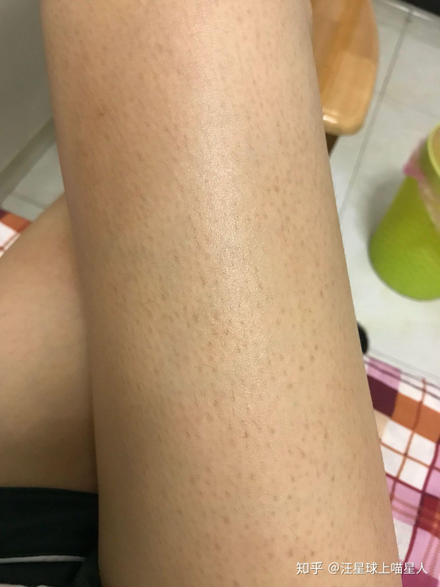 鸡皮肤及色素怎么去除?