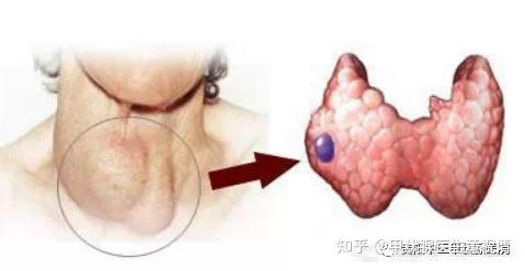 照镜子突然发现脖子上长了个东西,有点痛,原来是这么回事. - 知乎