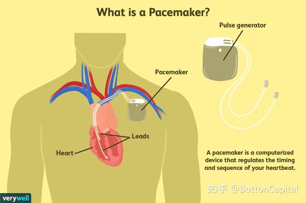心脏起搏器装在哪里图片