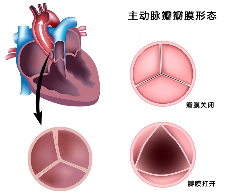 一,导致主动脉瓣狭窄的病因