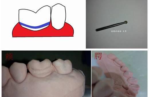 右上第一磨牙 石膏模型全瓷冠 牙体预备下面总结一个全冠预备的方法