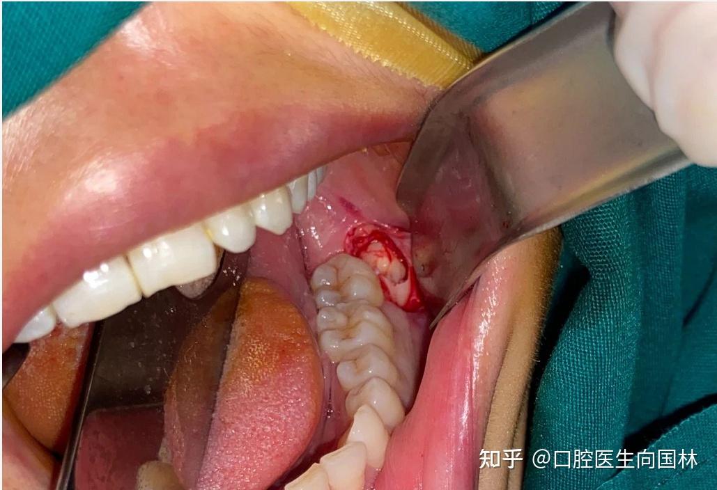 28岁女子左下后牙反复不适检查后发现智齿倒生长