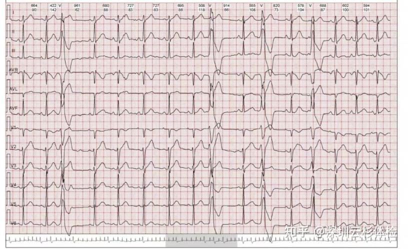 右心室心电图图片