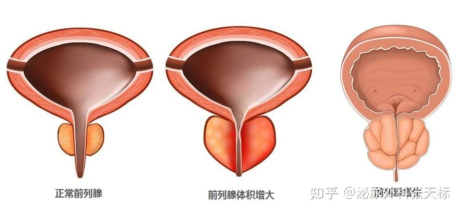 前列腺增生指前列腺明显增大而影响男性健康的一种疾病  男性随着年